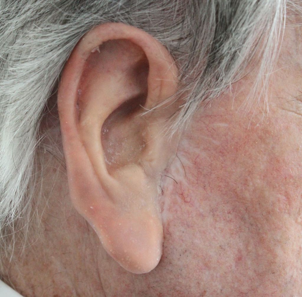 Protesi epitesi maxillo facciale - orecchio