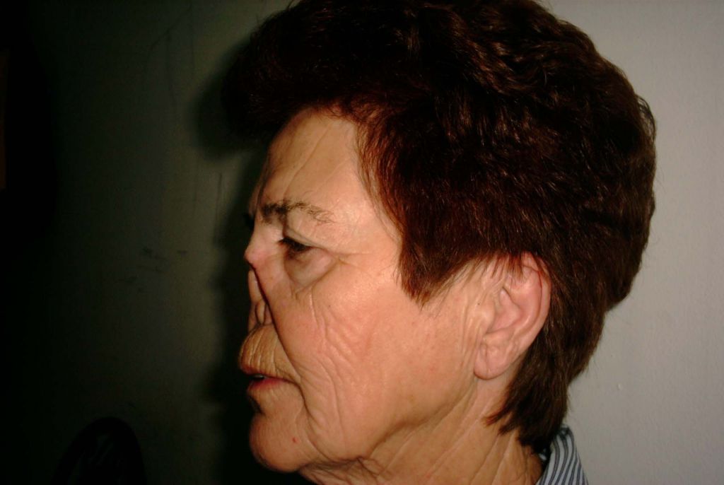 Protesi epitesi maxillo facciale - naso