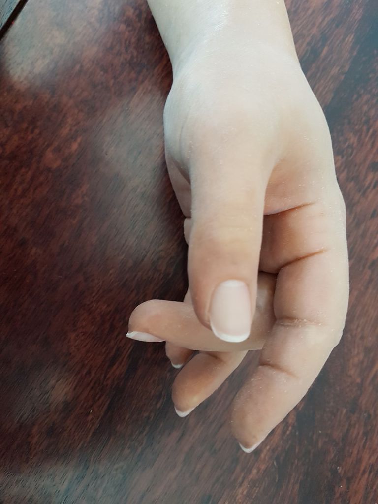 Protesi ProArt - mano dita